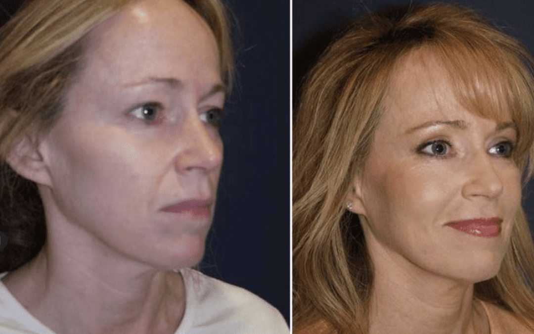 Charlotte’s best facial plastic surgeon explains reasons for hiring a specialist