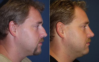 Nose job in Charlotte NC: top facial surgeon debunks popular myths