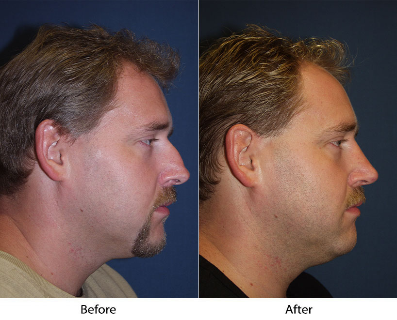 Nose job surgery in Charlotte from the best rhinoplasty surgeon