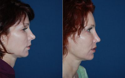 Revision rhinoplasty expert in Charlotte NC