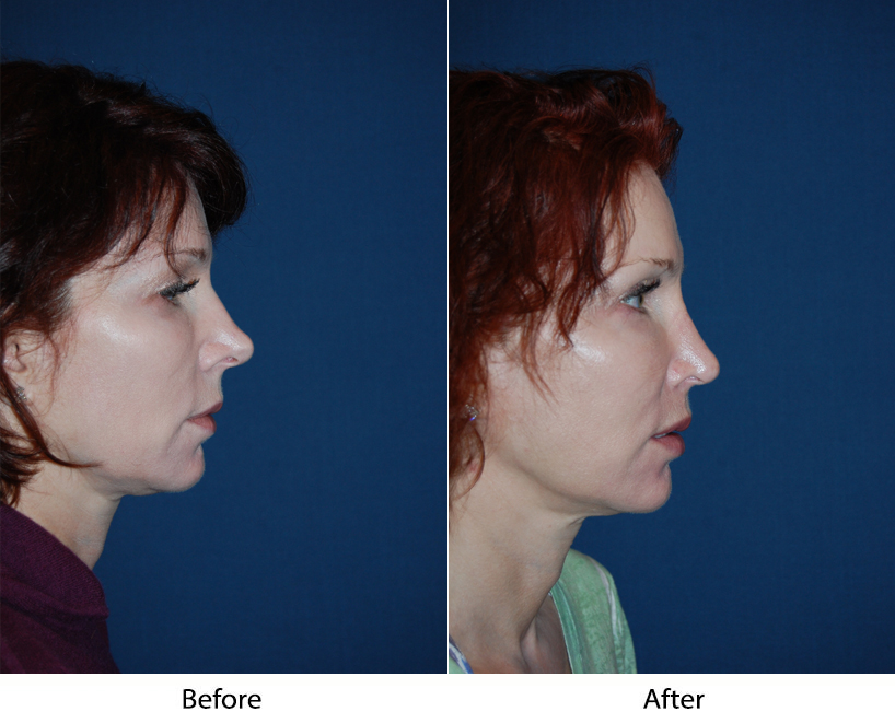 Revision rhinoplasty means you need to see the most experienced surgeon to fix your nose