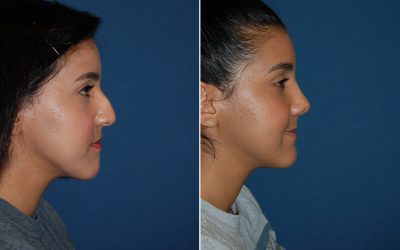 Rhinoplasty is for when you’re ready