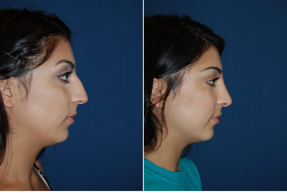Rhinoplasty and alar rim surgery in Charlotte NC from top facial plastic surgeon