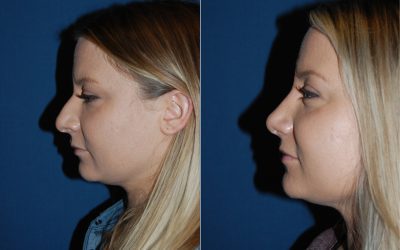 Hundreds of thousands of rhinoplasties a year