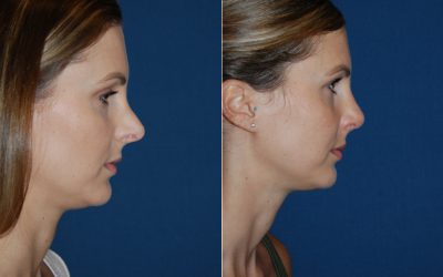 Charlotte’s best rhinoplasty surgeon can improve your facial balance
