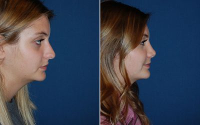 Quality rhinoplasty available in Charlotte