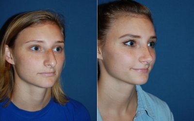 Nose jobs from Charlotte’s top cosmetic surgeon