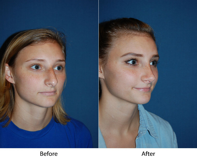 Different noses, different rhinoplasties