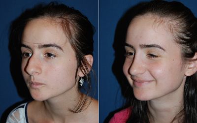 Rhinoplasty expert in Charlotte performs nose surgery with chin augmentation