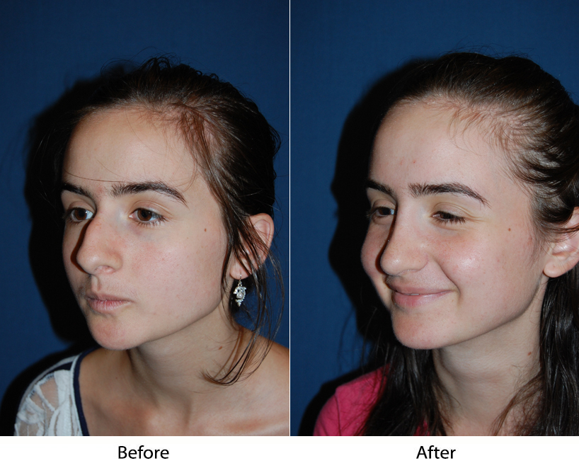 Find the best rhinoplasty expert in Charlotte, NC