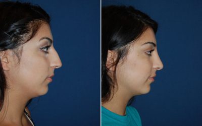 Is teen rhinoplasty in Charlotte, NC, safe? Ask the top facial plastic surgeon