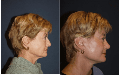 Going through the process of rhinoplasty