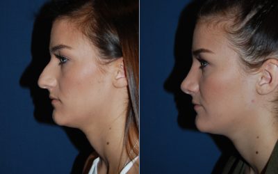 Rhinoplasty surgery, recovery, and specialist in Charlotte, NC