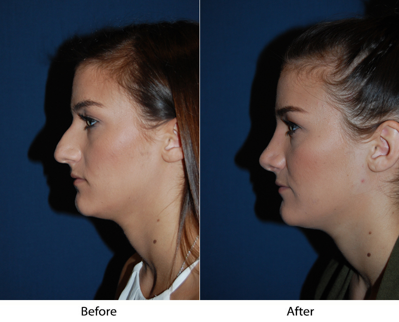 Rhinoplasty surgery, recovery, and specialist in Charlotte, NC