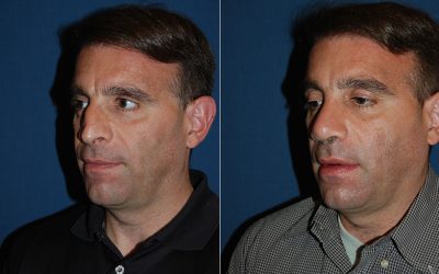 Rhinoplasty to look more male or female