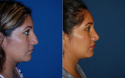 Rhinoplasty a popular form of cosmetic surgery