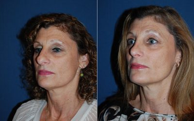 Charlotte’s best rhinoplasty surgeon can improve your nose