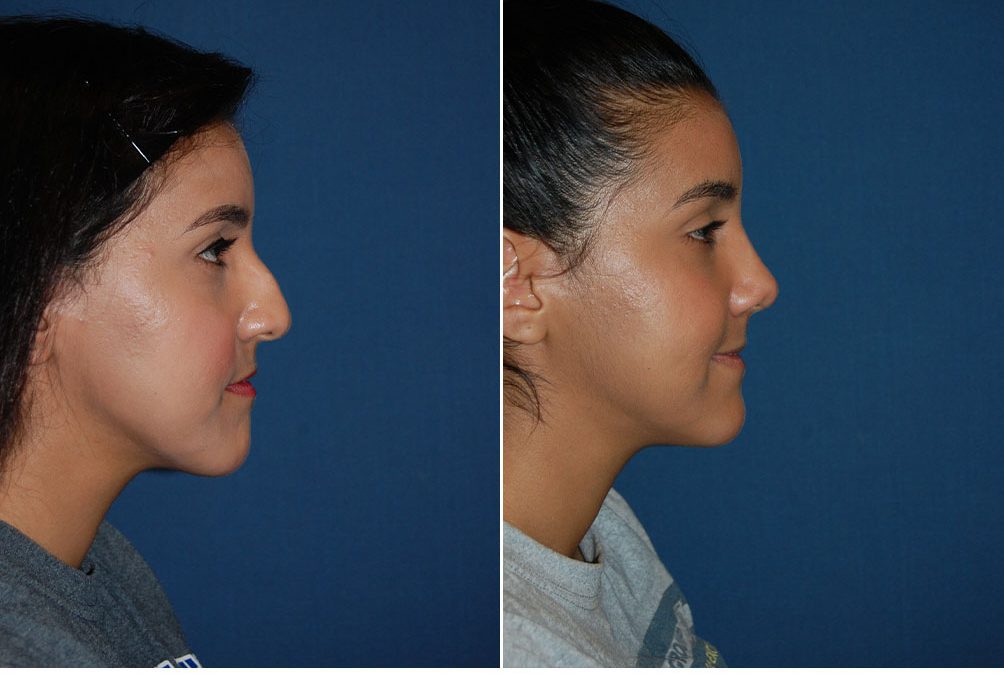Nose job surgeons in Charlotte, NC does revision rhinoplasty