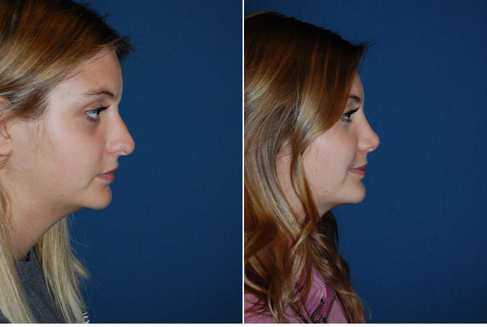 Nose job surgeon in Charlotte NC explains preparations for rhinoplasty surgery