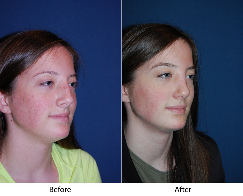 Teen rhinoplasty popular as consciousness of appearance grows