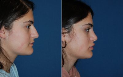 Teen rhinoplasty surgeon in Charlotte NC, Dr. Sean Freeman, is here for your nose job
