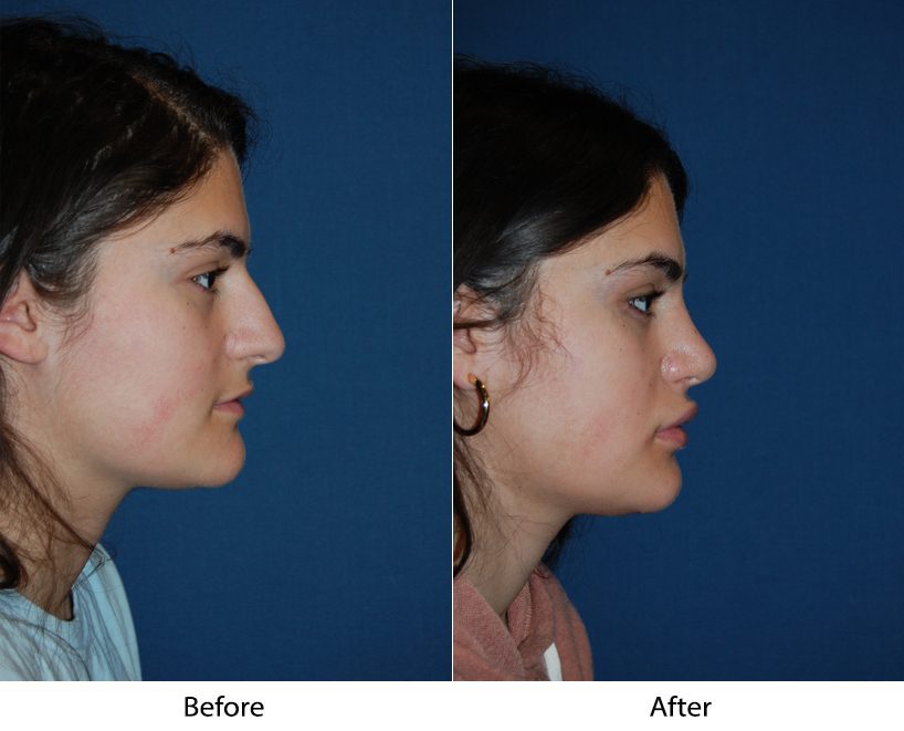 What are top tips for teen Rhinoplasty in Charlotte NC?