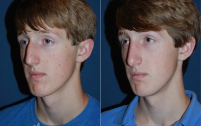 Teen rhinoplasty surgeons in Charlotte NC offers a guide for when your teen wants a nose job