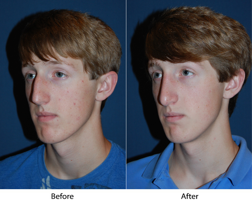 Teen rhinoplasty surgeons in Charlotte NC offers a guide for when your teen wants a nose job