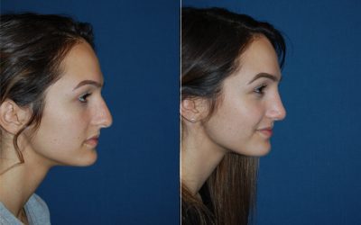 Teen rhinoplasty surgeons in Charlotte NC shares considerations for a teenage nose job