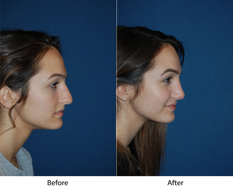 Teen rhinoplasty surgeons in Charlotte NC shares considerations for a teenage nose job