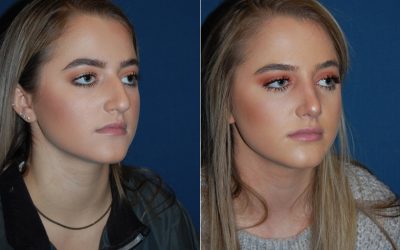 Teen rhinoplasty surgeons in Charlotte NC to get your teen’s nose fixed