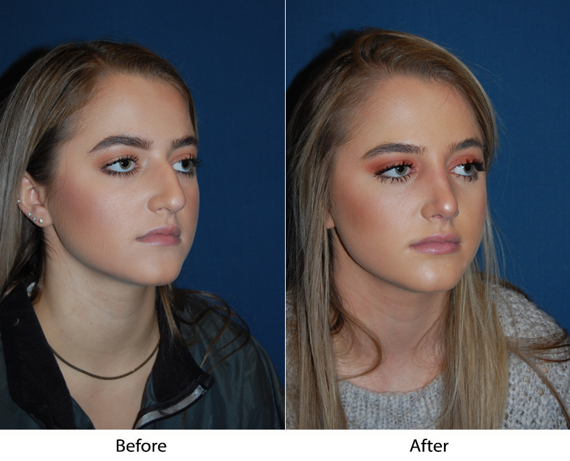 Teen rhinoplasty surgeons in Charlotte NC to get your teen’s nose fixed