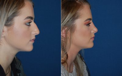 Teen rhinoplasty surgeons in Charlotte NC give parents tips