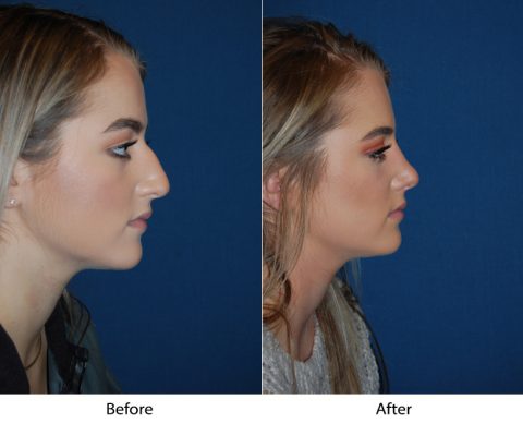 Best teen nose job surgeon for a teen rhinoplasty in Charlotte, NC