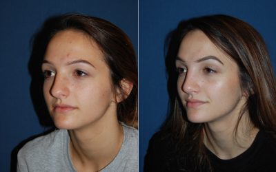 Teen rhinoplasty surgery can help improve your child’s self-confidence