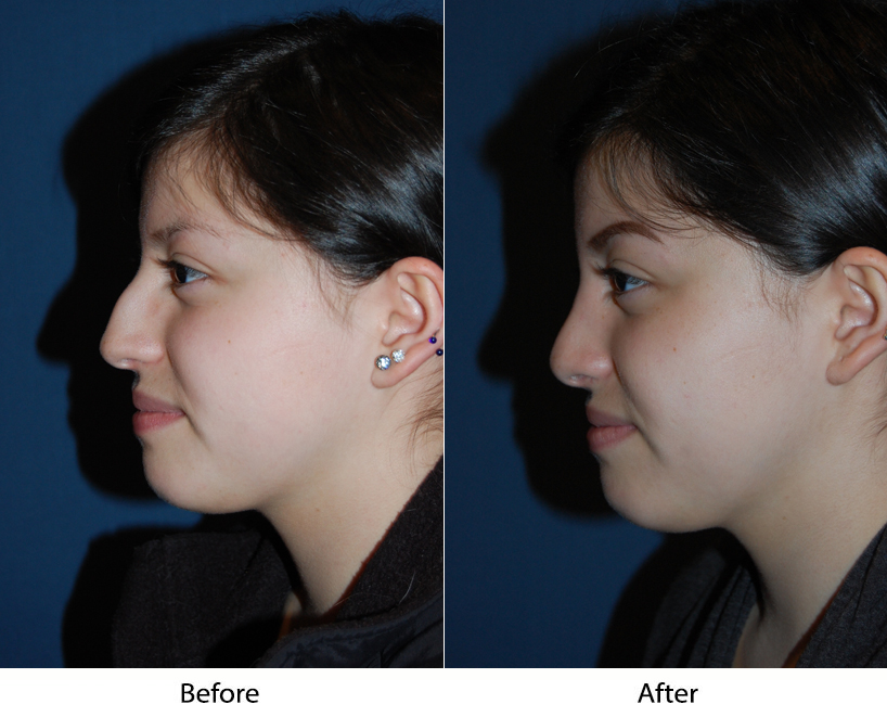 Teen rhinoplasty surgeons in Charlotte explain the popularity of nose jobs