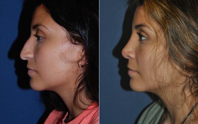 Charlotte’s best rhinoplasty expert explains nose job’s positive effects