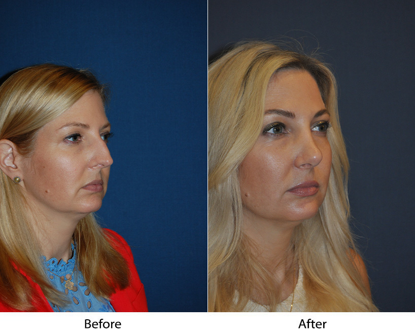 Charlotte’s best nose job surgeon debunks common rhinoplasty myths