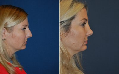 Charlotte’s rhinoplasty specialist explains enjoyable activities for recovering patients