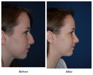 Charlotte’s best rhinoplasty surgeon explains facts about rhinoplasty recovery