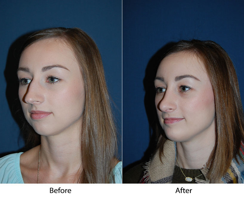 Charlotte’s teen rhinoplasty surgeons explain nose job for teens
