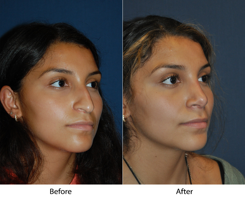 Best Charlotte Rhinoplasty surgeons explain what to look for in a specialist