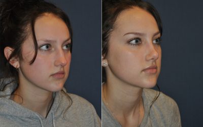 Best Charlotte Rhinoplasty Surgeon: Reasons for Revision
