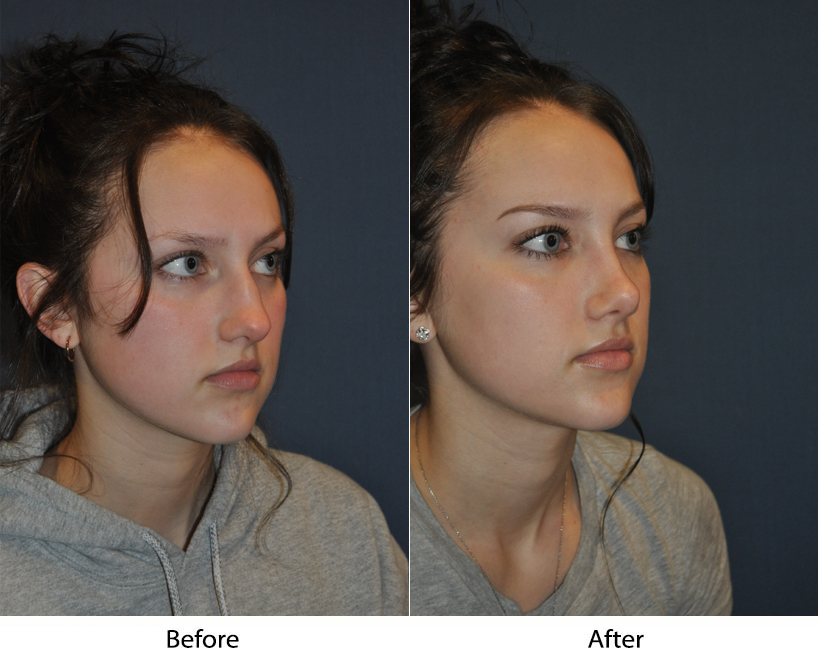 Best Charlotte Rhinoplasty Surgeon: Reasons for Revision