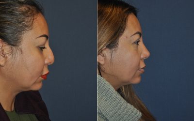 Charlotte’s top rhinoplasty expert offers recovery tips