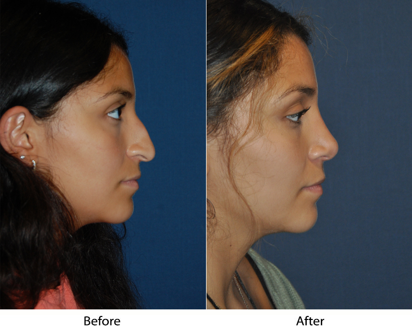 Charlotte’s Top Nose Job Surgeon – Rhinoplasty to Help with Breathing