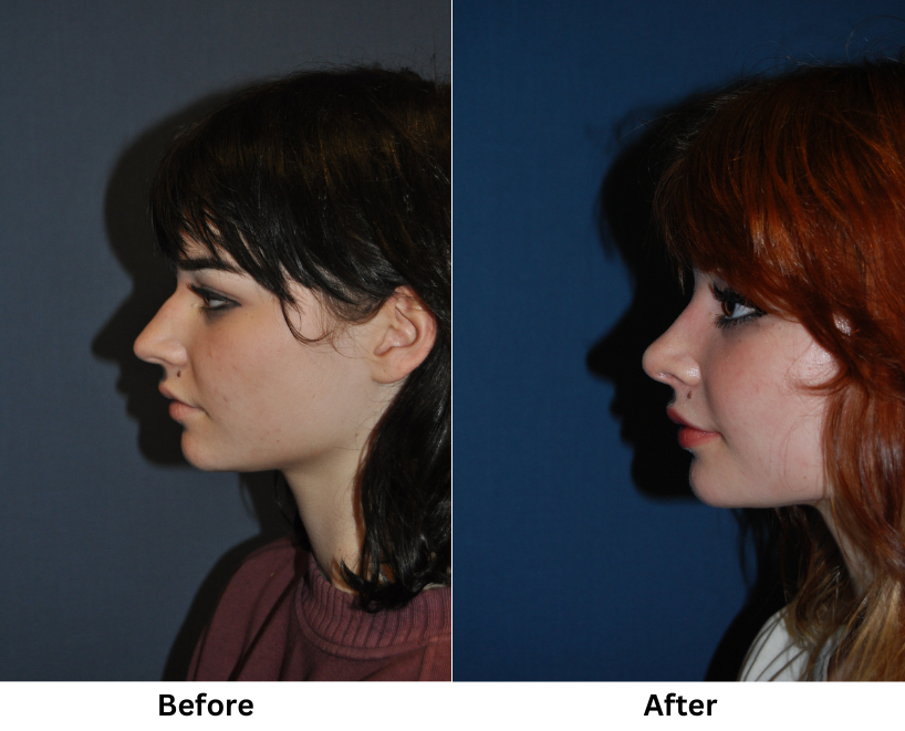 Charlotte’s Rhinoplasty Surgeon: Pain, Risks, and Recovery