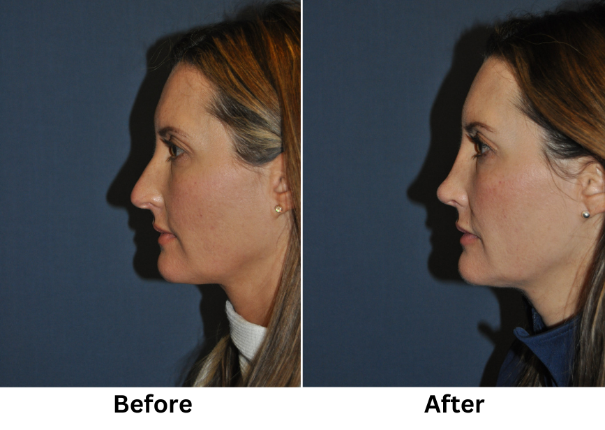 Rhinoplasty Specialist in Charlotte NC Gives Realistic Expectations