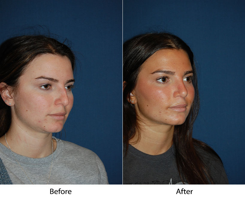Charlotte’s Top Teen Rhinoplasty Surgeons Helps WIth Informed Decisions