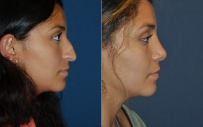 Charlotte’s Top Rhinoplasty Specialist Discusses Possible Post-Surgery Issues